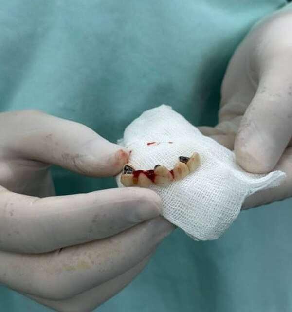 Popular / Un hombre fue tratado por asma, pero había sido se tragó una paladar