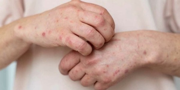 Confirman 45 casos de sarampión en San Pedro y Central; autoridades refuerzan vacunación - ADN Digital