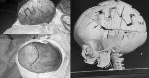 Diario HOY | Realizan compleja cirugía de remodelación craneal a una bebé en IPS