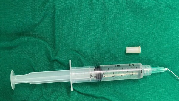 Niña de 3 años traga un silbato: “Cuando se reía silbaba, se convirtió en trompeta”, dice médico