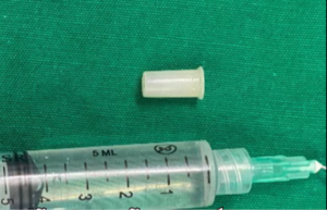 Extraen silbato de los pulmones de una niña de 3 años