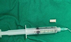 Niña de 3 años traga un silbato: “Cuando se reía silbaba, se convirtió en trompeta”, dice médico – Prensa 5