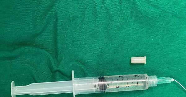 Diario HOY | Niña de 3 años “se convirtió en trompeta” al tragar un silbato que recogió de una piñata