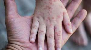San Pedro concentra la mayoría de los casos de sarampión en el país