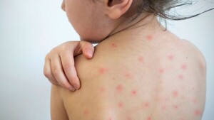De los 49 pacientes con sarampión, siete fueron internados