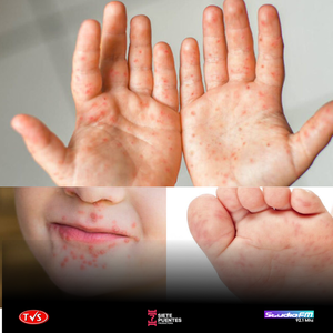 AUMENTAN CASOS DE LA ENFERMEDAD MANO, BOCA Y PIE - «TVS DIGITAL»