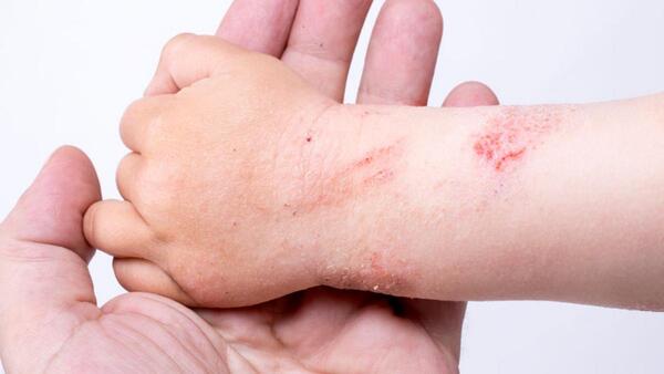 Epidermólisis Bullosa: ¿Qué es la enfermedad también conocida como piel de mariposa?