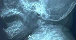 La Nación / Bebé de diez meses tragó un arito, pero ya está fuera de peligro