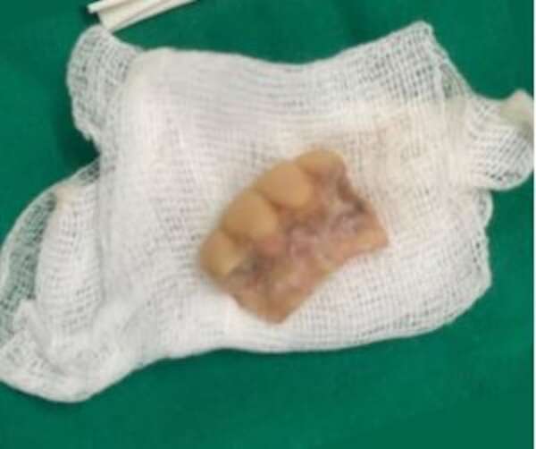 Extraen prótesis dentaria de la laringe de un hombre - Nacionales - ABC Color