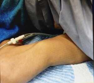 Popular / Denuncia de supuesta negligencia en el Hospital de Villa Hayes: Le fracturaron su pierna a una doñita que ingresó para amputación