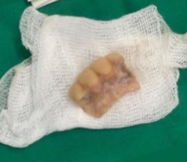 Médicos del Ineram extraen prótesis dental de la laringe de un hombre - trece