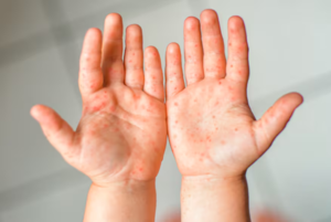 Alerta por brote de enfermedad Mano, Pie y Boca en niños