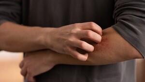 Hablemos de psoriasis: Derribando mitos de una enfermedad visible pero incomprendida