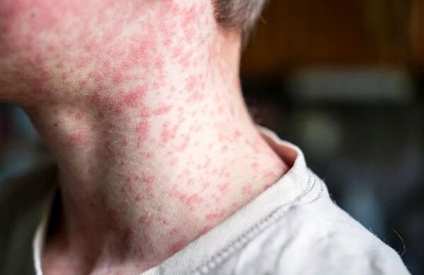 Popular / Sarampión: Hay casos sospechosos y 49 enfermos confirmados