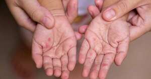 La Nación / Paraguay no reporta casos confirmados de sarampión hace cinco semanas