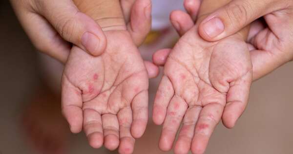 La Nación / Paraguay no reporta casos confirmados de sarampión hace cinco semanas