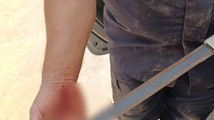 Policía se enfrentó a machetero y fue herido en la mano