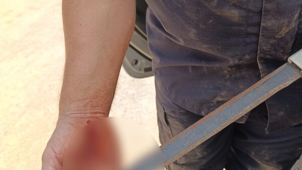 Policía se enfrentó a machetero y fue herido en la mano