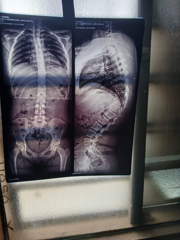 Popular / Joven madre oikotevē ayudomi para juntar 60 millones y operarse de la columna