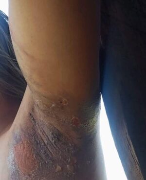 suegra arroja agua hirviendo a su nuera y le provoca quemaduras de segundo grado