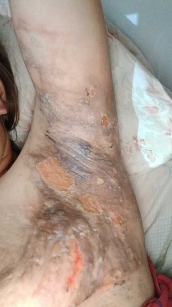 Popular / Suegra derramó agua hirviendo a su nuera