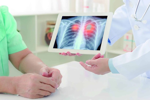 IA Detecta Cáncer: Reduce Mortalidad Pulmonar 24%