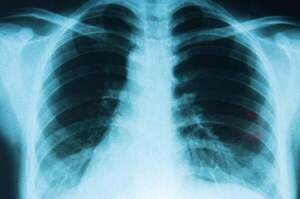 Cáncer de Pulmón: enfermedad prevenible con alta tasa