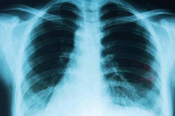 Cáncer de Pulmón: enfermedad prevenible con alta tasa