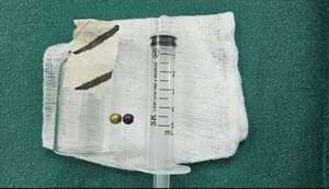 Extraen collar de perlas del aparato digestivo y pulmón de una niña de cuatro años  - Nacionales - ABC Color