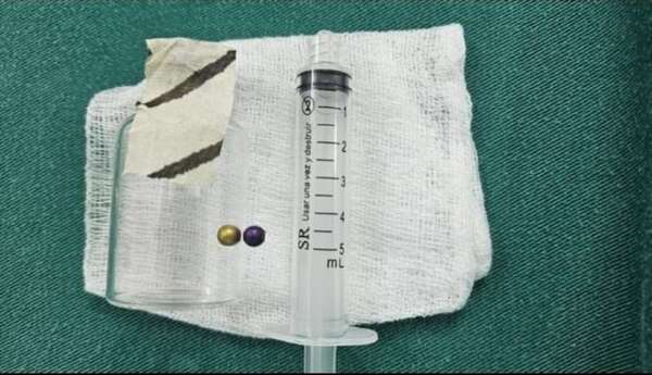 Extraen collar de perlas del aparato digestivo y pulmón de una niña de cuatro años  - Nacionales - ABC Color