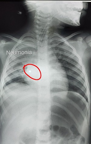 Niña de 4 años tragó un collar de perlas: "Causó una catástrofe en los pulmones" - trece