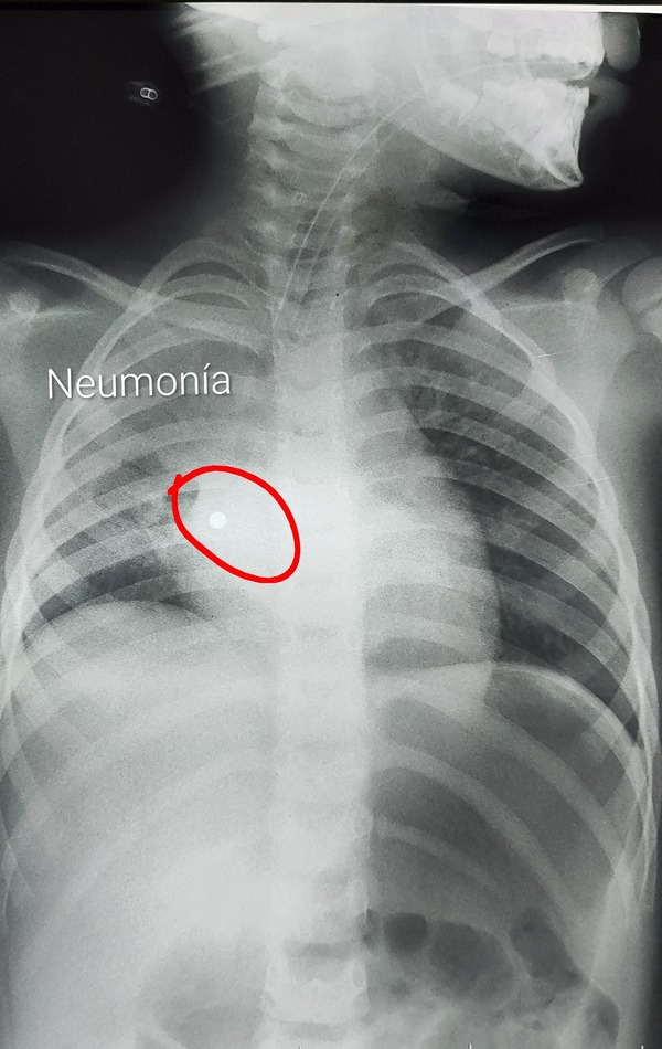 Niña de 4 años tragó un collar de perlas: "Causó una catástrofe en los pulmones" - trece