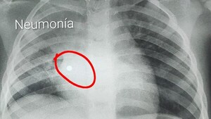 Nena de 4 años tragó cinco perlas y acabó en terapia intensiva