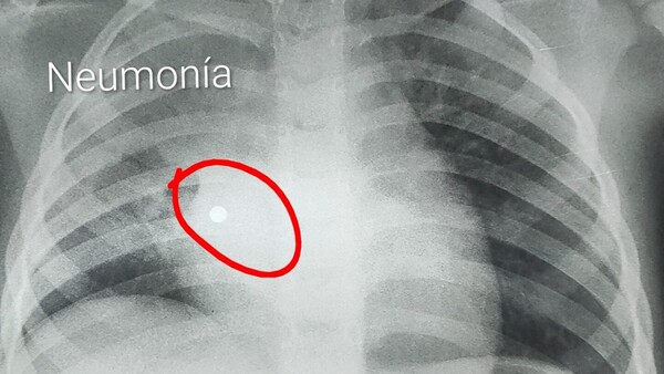Nena de 4 años tragó cinco perlas y acabó en terapia intensiva