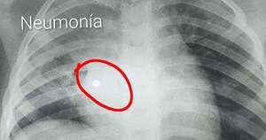 La Nación / Niña de 4 años tragó un collar de perlas: tras intervención lograron salvar su vida en el Ineram