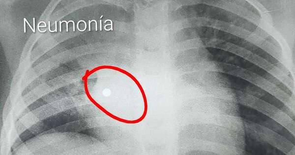 La Nación / Niña de 4 años tragó un collar de perlas: tras intervención lograron salvar su vida en el Ineram