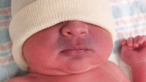 Tetralogía de Fallot: condición muy frecuente en Paraguay, caracterizada por coloración azul en la piel