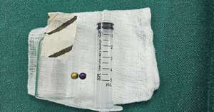 Diario HOY | Niña de 4 años sobrevive tras aspirar una perlita metálica