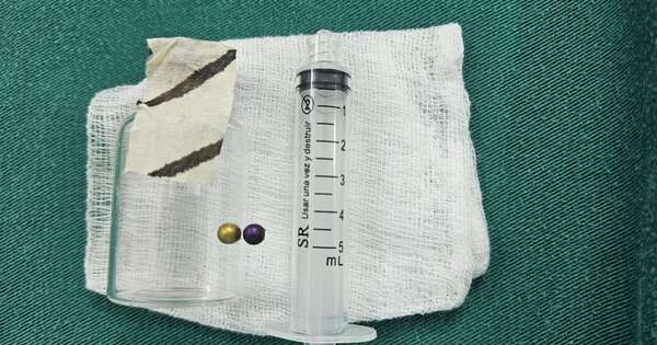 Diario HOY | Niña de 4 años sobrevive tras aspirar una perlita metálica