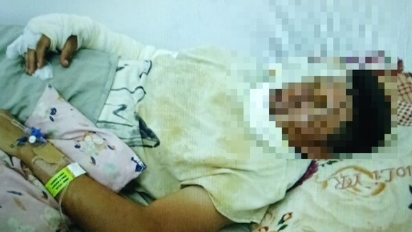 Mozo se quemó casi todo el cuerpo en un evento chuchi