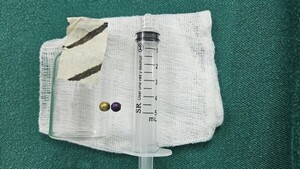 Médicos del Ineram salvan a niña de 4 años al extraer perla metálica del pulmón