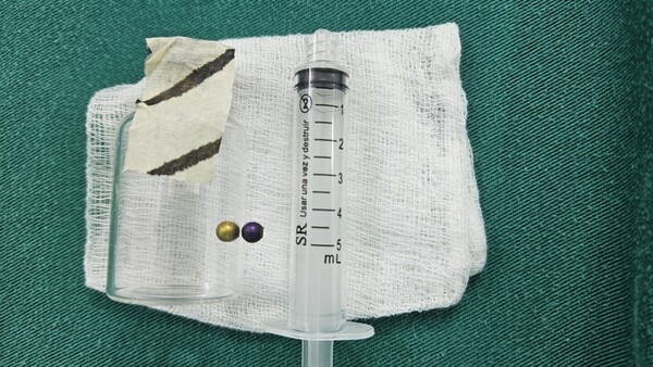 Médicos del Ineram salvan a niña de 4 años al extraer perla metálica del pulmón