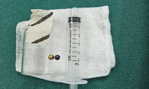 Capiatá: Niña sobrevive tras aspirar peligrosa perlita metálica - OviedoPress