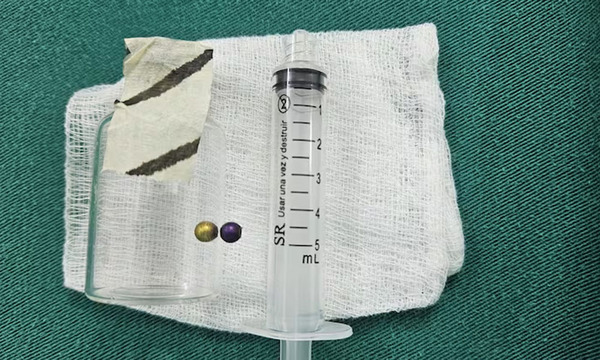 Capiatá: Niña sobrevive tras aspirar peligrosa perlita metálica - OviedoPress