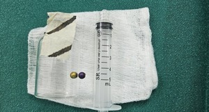 Niña se recupera tras extraerle perla metálica del pulmón