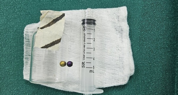 Niña se recupera tras extraerle perla metálica del pulmón