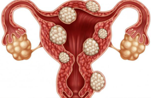 La ablación por radiofrecuencia tiene un éxito superior al 80 frente a los miomas uterinos