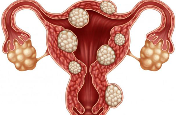 La ablación por radiofrecuencia tiene un éxito superior al 80 frente a los miomas uterinos