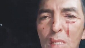 “Esa caminera me arañó y me reventó la cara”