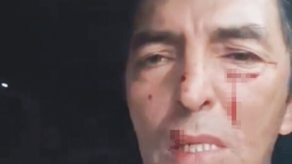 “Esa caminera me arañó y me reventó la cara”